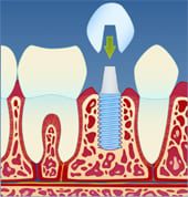 Implantat3