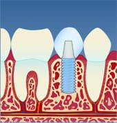 Implantat4
