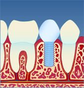 Implantat5
