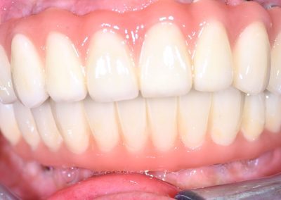etter implantatbehandling full kjeve 2