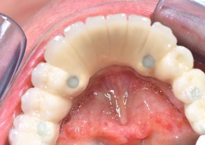 etter implantatbehandling underkjeve