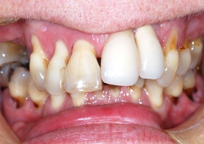 for implantatbehandling full kjeve 2