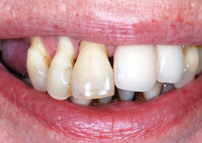 for implantatbehandling full kjeve