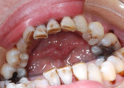 for implantatbehandling underkjeve